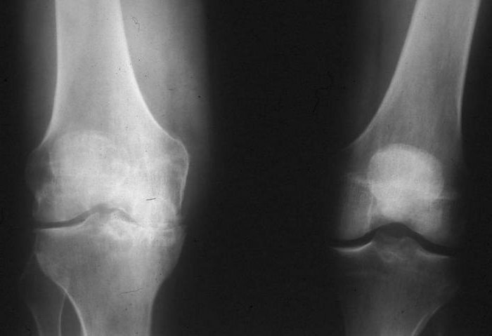 synovial knee joint