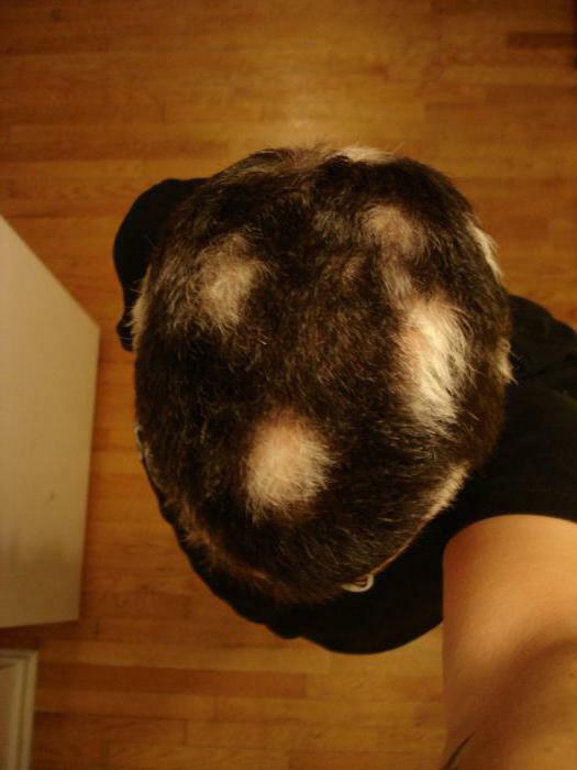 focal alopecia in men treatment photo