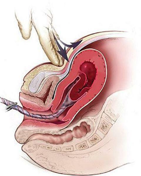 methods of manual removal of the placenta