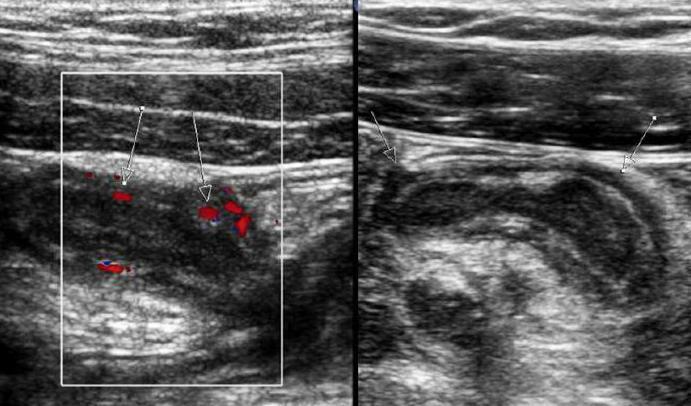 the-first-symptoms-of-appendicitis-in-a-child-10-years-old