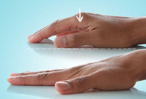 osteoarthritis of hands