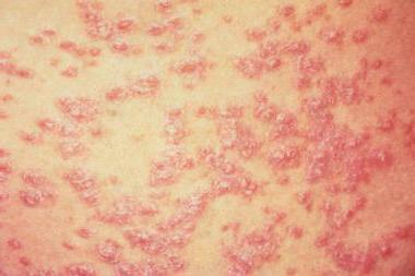 antibodies for psoriasis