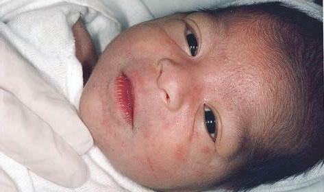 Vesiculopustulosis in newborns