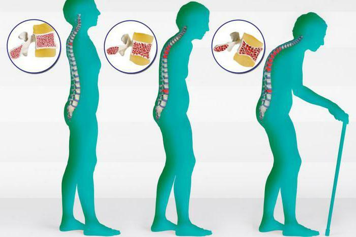 diffuse osteoporosis of the spine