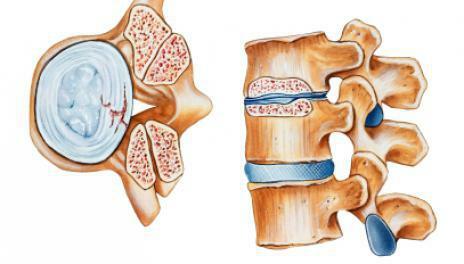 stenosis of the spinal canal of the lumbosacral spine