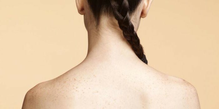 Teenage acne in girls on back treatment