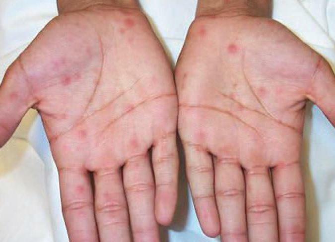 Rashes on the palms and soles of the child and adult causes of allergies