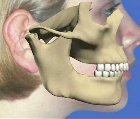 dislocarea maxilarului