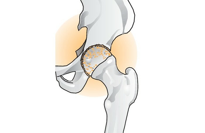 كوكسارثروسيس - العلاج في المنزل