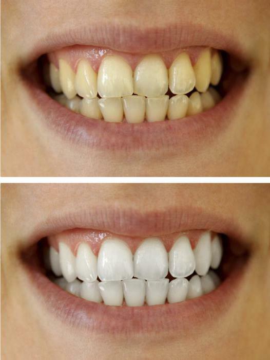 Crest 3D white whitestrips Profesionálne efekty