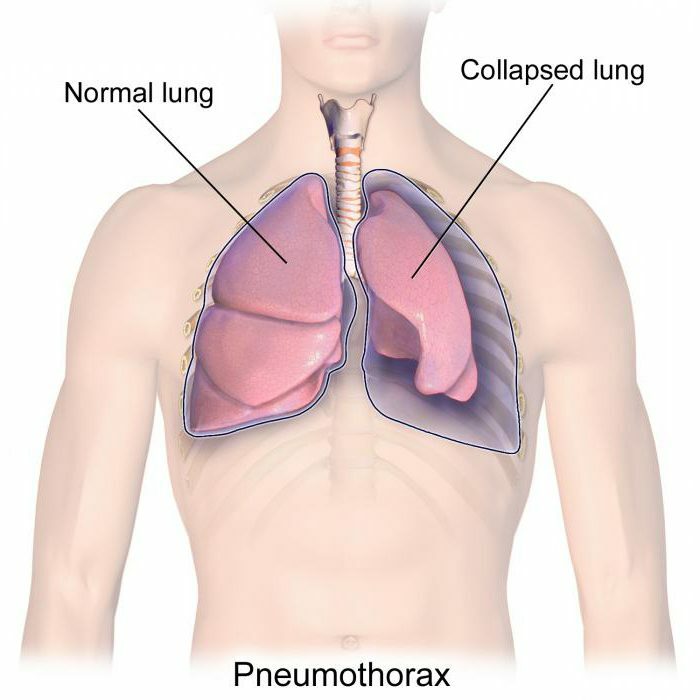 types of pneumothorax first aid