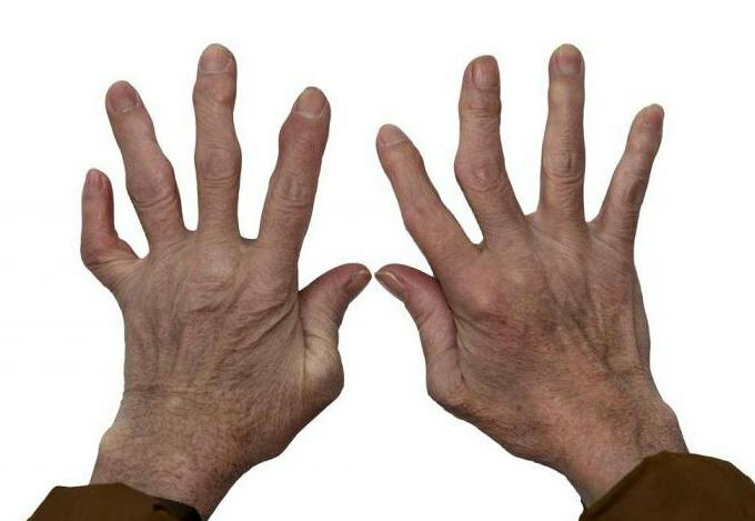 prevention of rheumatoid arthritis