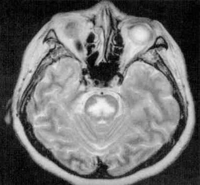 brain tumor of the brain stem