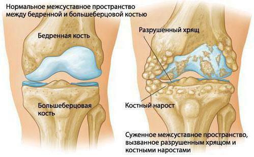 synovial hip