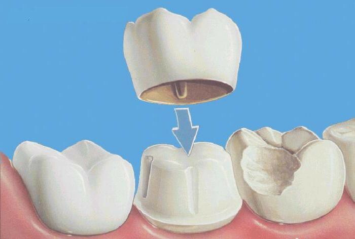dental prosthetics