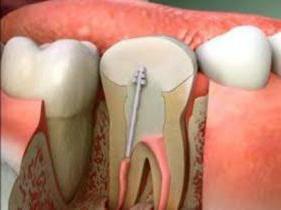 methods of root canal filling
