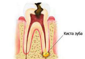 The tooth without a nerve at nibble hurts