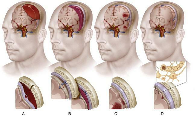 contusion and compression of the brain