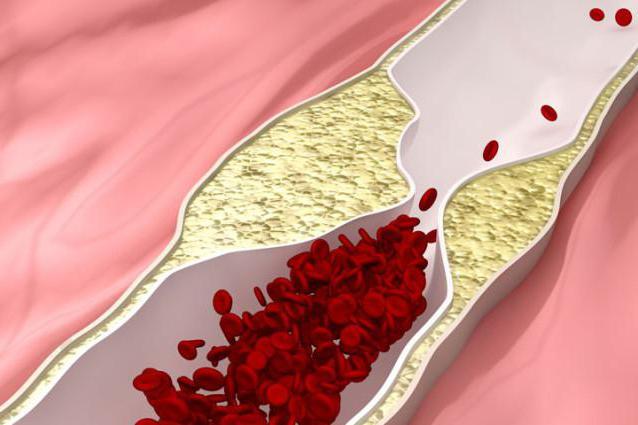 atherosclerosis stenosing