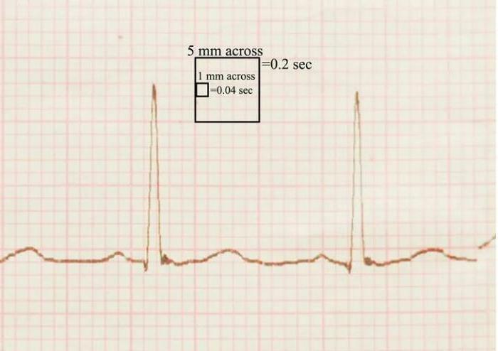 Sinusrytme på EKG