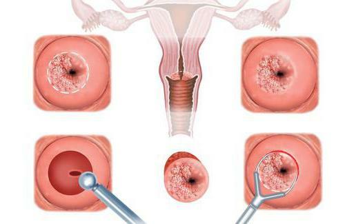 cervical ectopia of the cervix