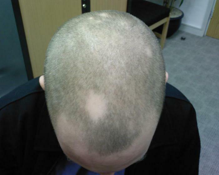 focal alopecia in men treatment reviews