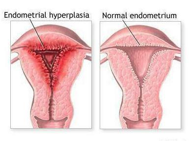 Norkolut cu hiperplazie endometrială