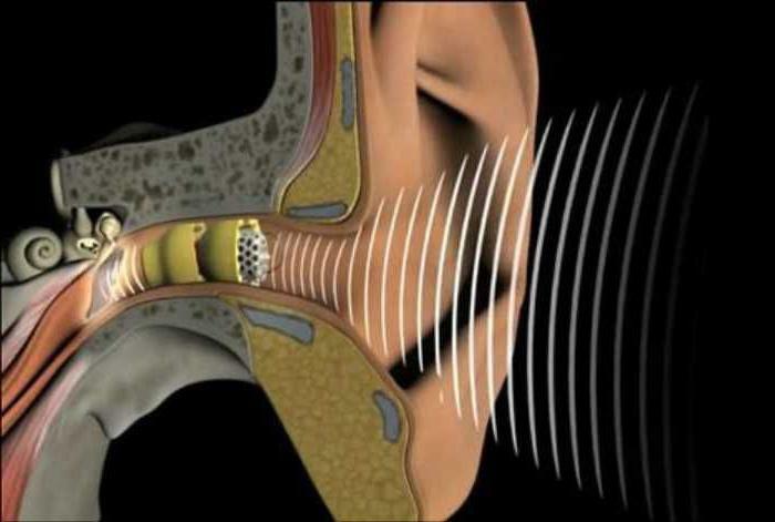 hearing restoration with sensorineural hearing loss