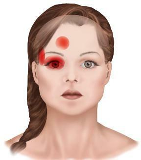 Headaches in temples and eyes