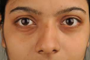 yellowing under the eyes causes and treatment