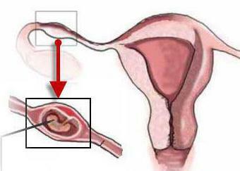 tubal pregnancy symptoms