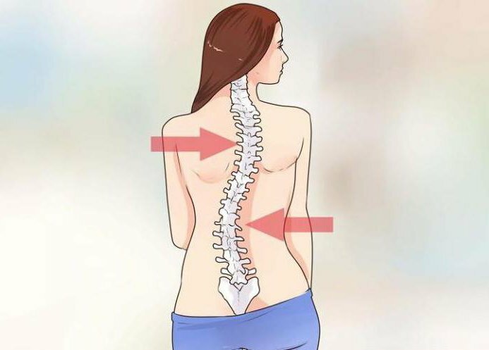 how to get rid of right-sided scoliosis