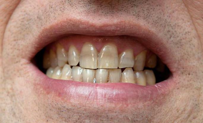 bleaching of tetracycline teeth before and after