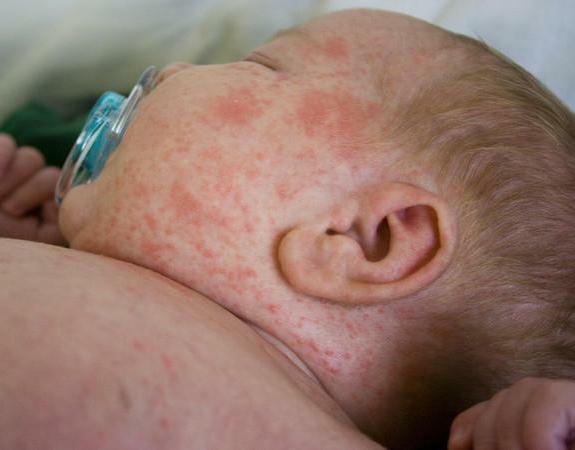 alergie na léčbu antibiotiky kožní vyrážky