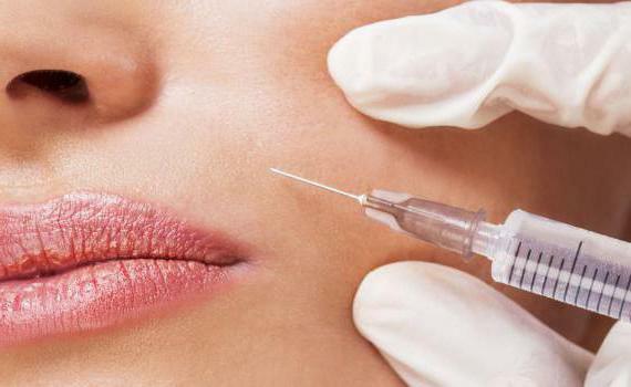 Contour lip plasty with hyaluronic acid