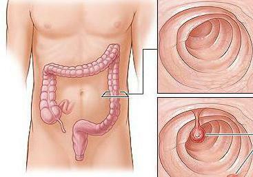 transversal de colon