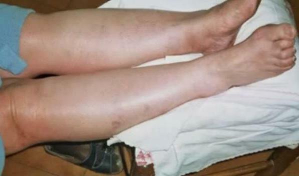 phlebitis of lower extremities symptoms and treatment of photos