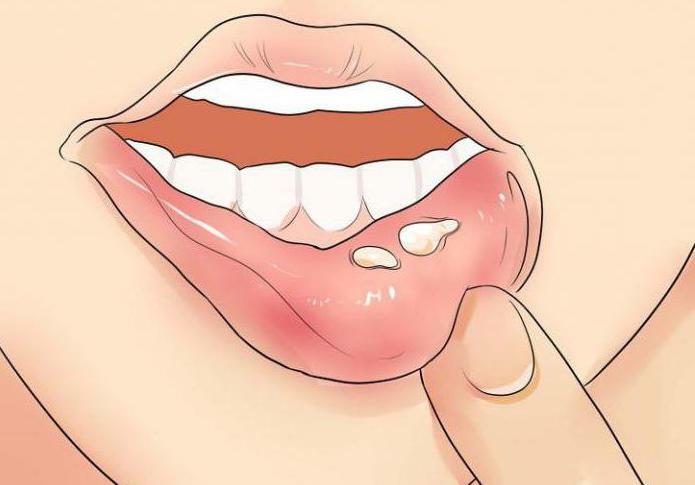 herpes on the lips causes and treatment