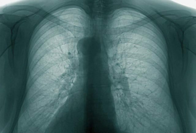 causes of obstructive bronchitis