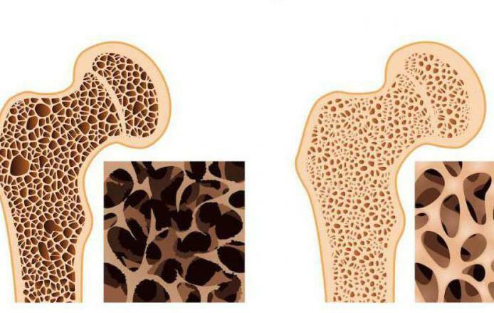 bone disease