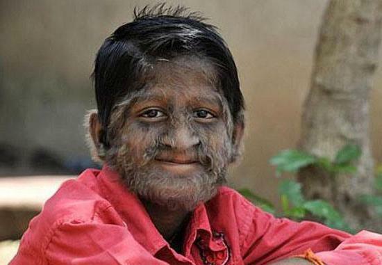 hypertrichosis is inherited as a trait