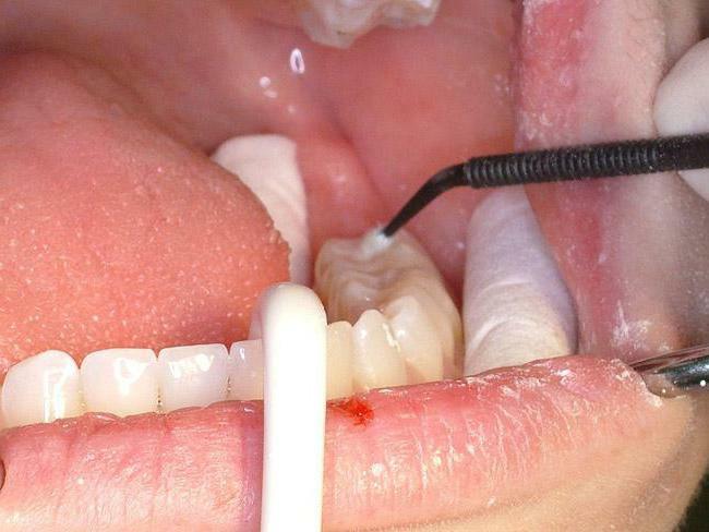 deepening of the chewing surface of the tooth