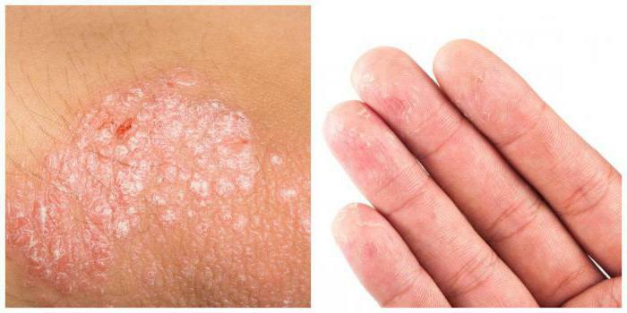 chronic microbial eczema