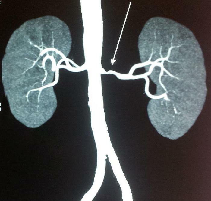 تضيق الشريان الكلوي الأيسر