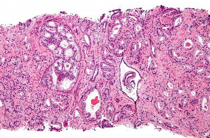 stage adenocarcinoma of the prostate