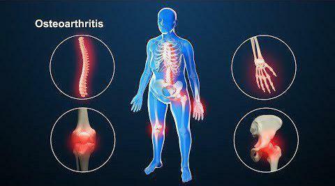 osteoarthritis of the joints