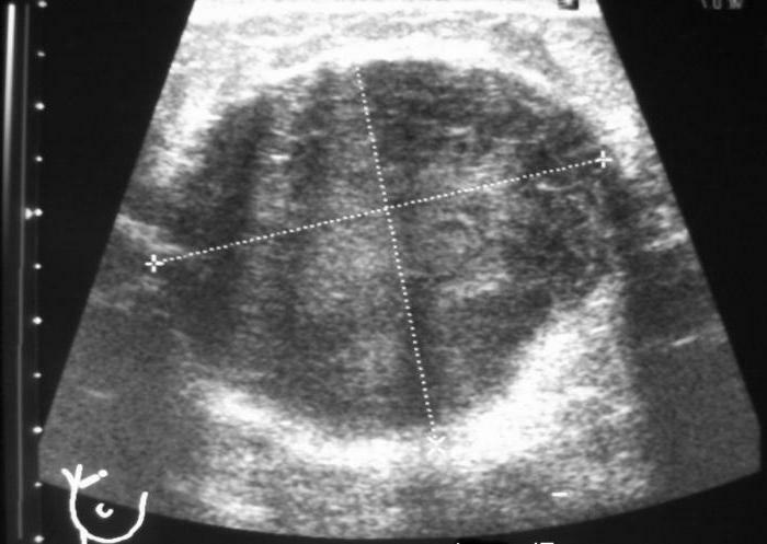 Ultrasound of the breast