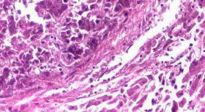 hepatocelularni karcinom