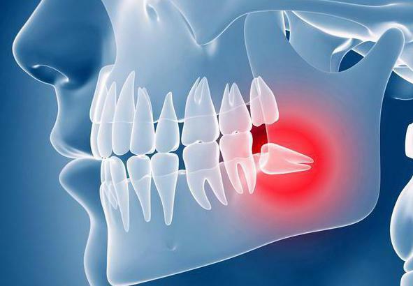 wisdom tooth why it is so called