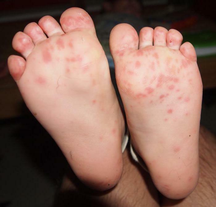 rash on the feet of a child
